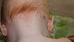 Токсокароз у детей: заражение, признаки и лечение