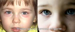 Синяки под глазами (тёмные круги). Причины, способы устранения и лечение