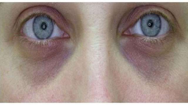 Синяки под глазами (тёмные круги). Причины, способы устранения и лечение