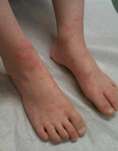 Красные высыпания на ноге у ребенка - советы врачей на каждый день