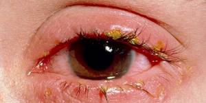 Болезнь на глазах - советы врачей на каждый день