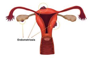 Секс при эндометриозе - советы врачей на каждый день