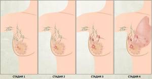 Рак груди 2аст - советы врачей на каждый день