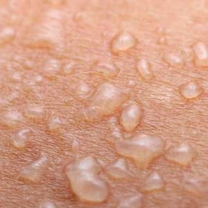 Непонятные пузырьки под кожей - советы врачей на каждый день