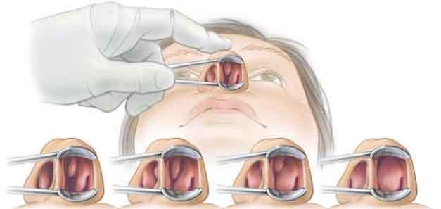 Вазотомия носовых раковин и лазерная коррекция зрения - советы врачей на каждый день