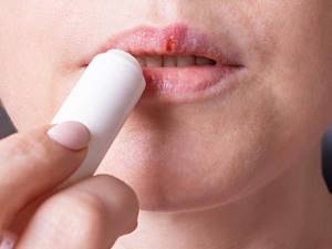 Белое уплотнение на губе после герпеса - советы врачей на каждый день