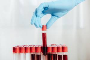 Результаты анализов крови - советы врачей на каждый день