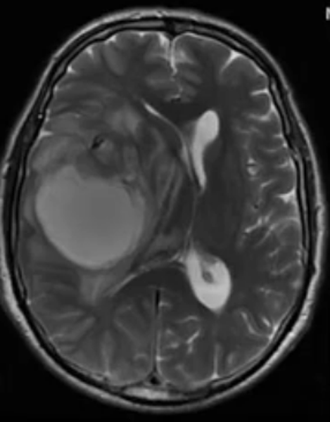 Прошу помощи в разъяснении результатов МРТ головного мозга - советы врачей на каждый день
