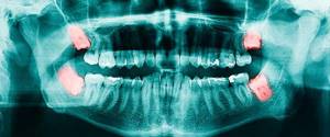 Боль в зубе - советы врачей на каждый день