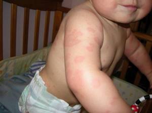 Акне новорождённых или аллергия - советы врачей на каждый день