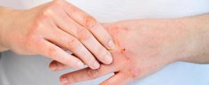 Что делать если не проходит воспаление на коже - советы врачей на каждый день