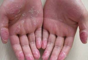 Зуд и шелушение кожи на кистях рук - советы врачей на каждый день