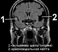 Киста головного мозга после ДТП - советы врачей на каждый день