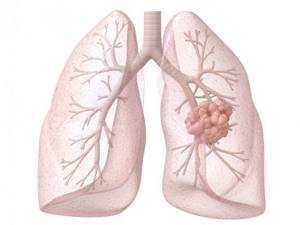 Железистый рак лёгких 4степень - советы врачей на каждый день
