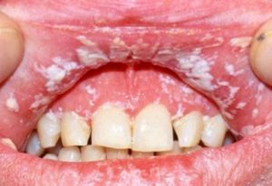 О болезни слизистой полости рта - советы врачей на каждый день