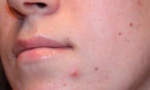 Прыщи на щеке - советы врачей на каждый день