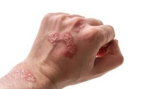 Сыпь на тыльной стороне правой руки - советы врачей на каждый день