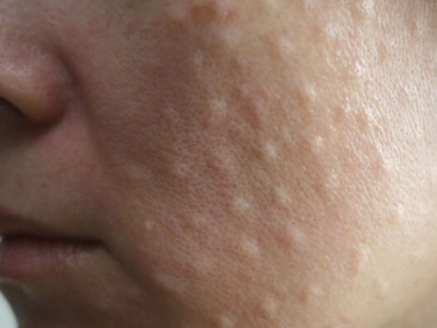 Аллергия.Краснота во все лицо - советы врачей на каждый день