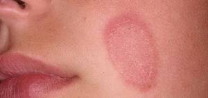 Грибок кожи на лице - советы врачей на каждый день