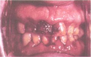 О болезни слизистой полости рта - советы врачей на каждый день