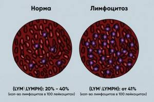 Высокие лимфоциты, почему могут быть такие показатели? - советы врачей на каждый день