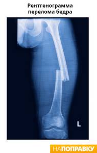 Перелом ноги со смещением - советы врачей на каждый день