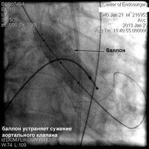 Кальцонированна сердечная аорта - советы врачей на каждый день