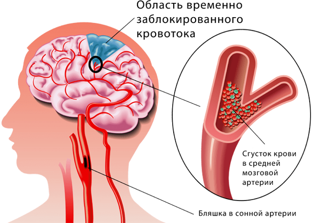Нарушение кровообращения головного мозга - советы врачей на каждый день