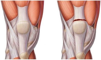 Растяжение связки коленного сустава - советы врачей на каждый день
