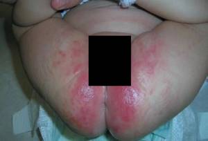 Сыпь на теле у ребенка уже месяц. Лечение не помогает - советы врачей на каждый день