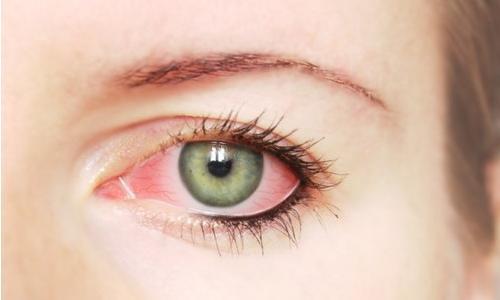 Покраснение глаз и чихание - советы врачей на каждый день