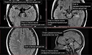 Очаги демиелизации головного мозга неясного генеза - советы врачей на каждый день