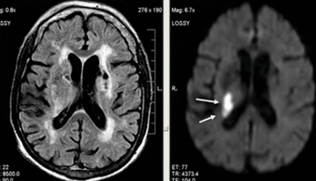 Прошу помощи в разъяснении результатов МРТ головного мозга - советы врачей на каждый день