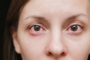 Краснота под глазом - советы врачей на каждый день