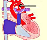 Открытый артериальный проток - советы врачей на каждый день