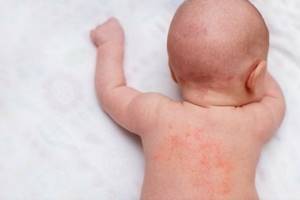 Алергия на смесь у ребенка - советы врачей на каждый день