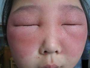Аллергия.Краснота во все лицо - советы врачей на каждый день
