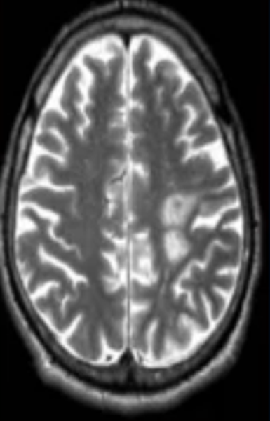 Очаги демиелизации головного мозга неясного генеза - советы врачей на каждый день