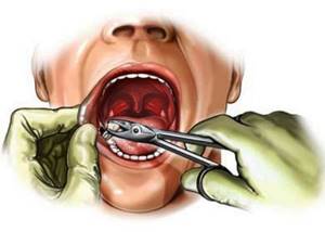 Стоит ли удалять зуб - советы врачей на каждый день