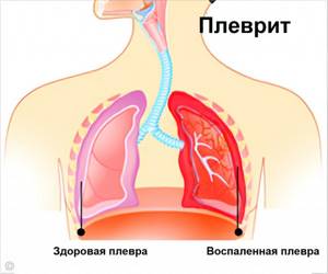 Головная боль при вдохе носом,кашле,чихании - советы врачей на каждый день