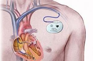Ставить ли кардиостимулятор в 20 лет - советы врачей на каждый день