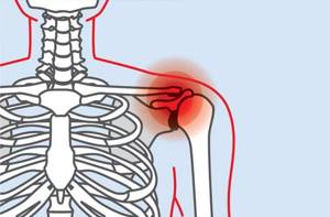 Артроз плечевого сустава 1 степени метод леченияю - советы врачей на каждый день