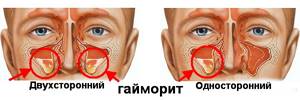 Щелканье в ушах после гацморита - советы врачей на каждый день