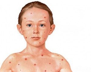 Вакцина от краснухи - советы врачей на каждый день