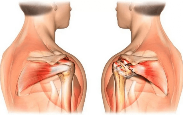 Боль в плечевом суставе - советы врачей на каждый день