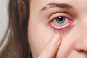 Краснота под глазом - советы врачей на каждый день
