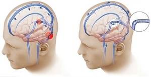 Диагноз Идиопатическая внутричерепная гипертензия Нарушение венозного оттока от головного мозга - советы врачей на каждый день