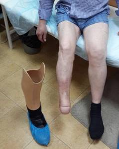 Что делать, если пожилой человек лежащий и на ногах ниже колена незаживающие раны - советы врачей на каждый день