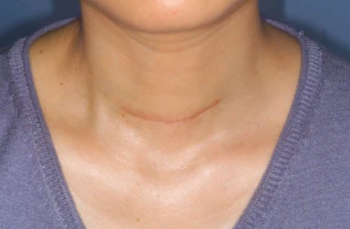 Пункция узла щитовидной железы - советы врачей на каждый день