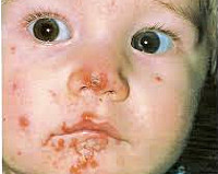 У ребенка на коже стрептаккокавая инфекция - советы врачей на каждый день